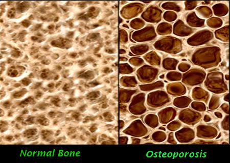 penyakit osteoporosis